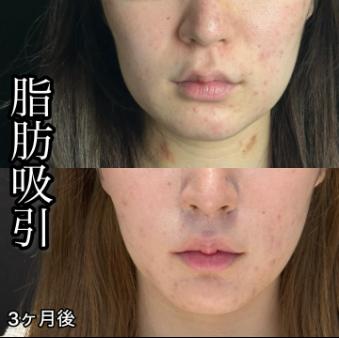 脂肪吸引の症例写真