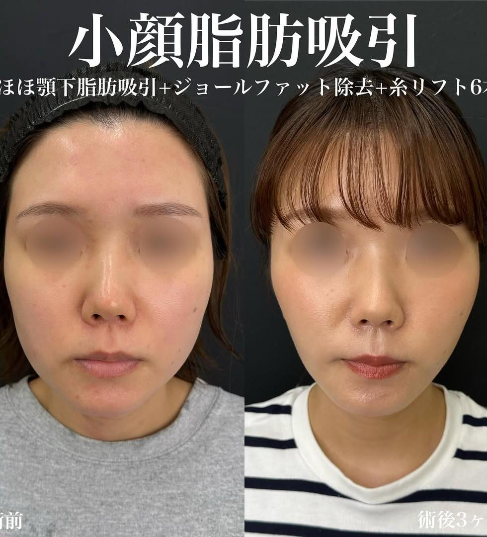 脂肪吸引の症例写真