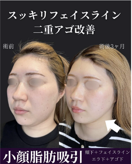 脂肪吸引の症例写真