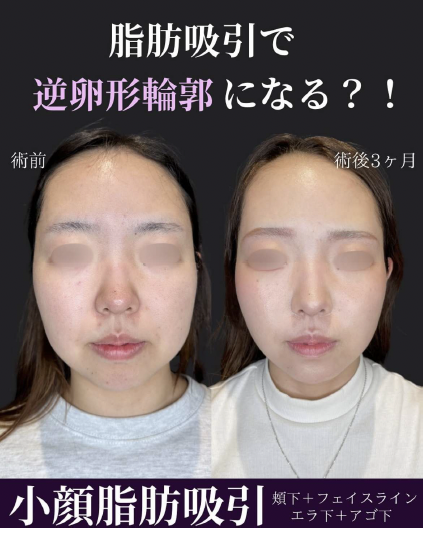 脂肪吸引の症例写真