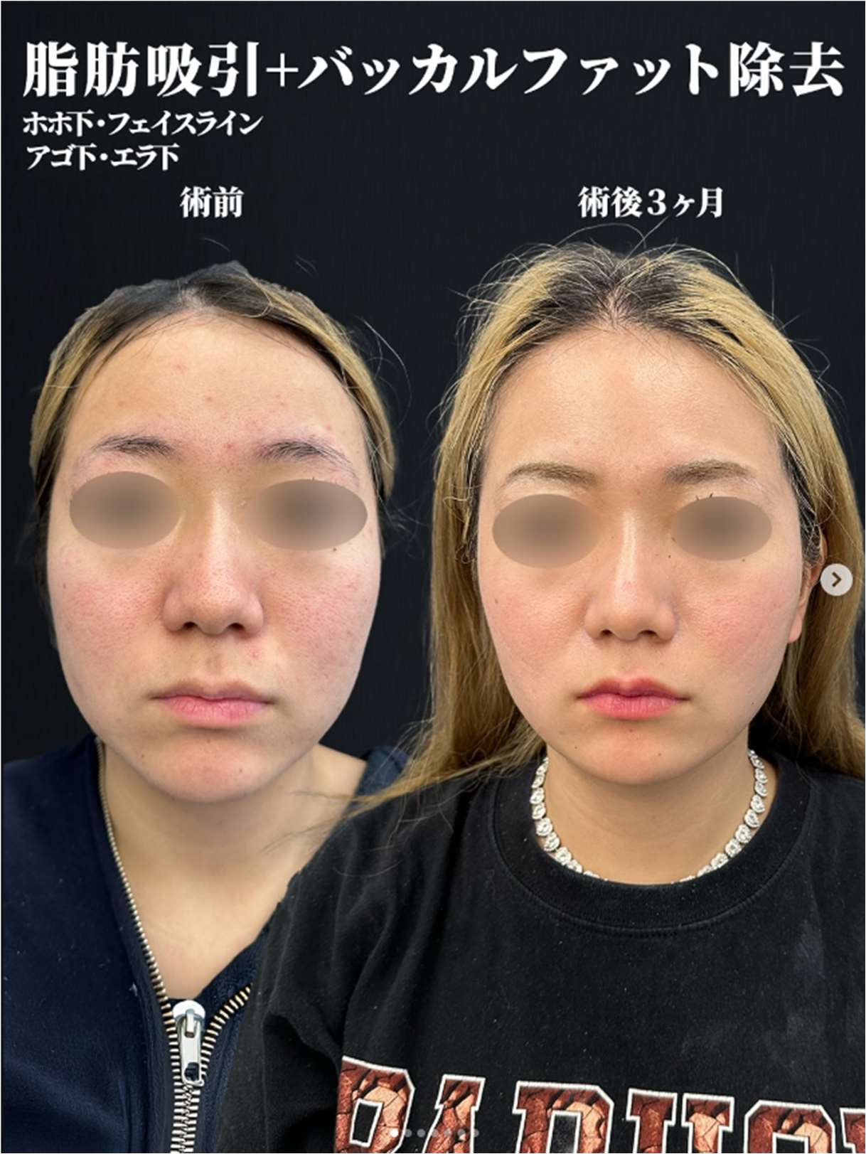 脂肪吸引の症例写真