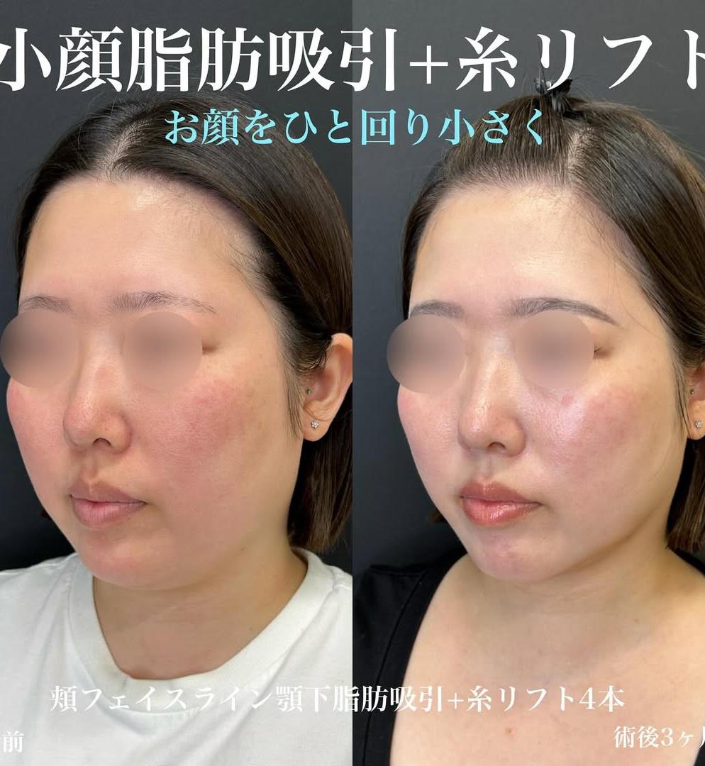 脂肪吸引の症例写真