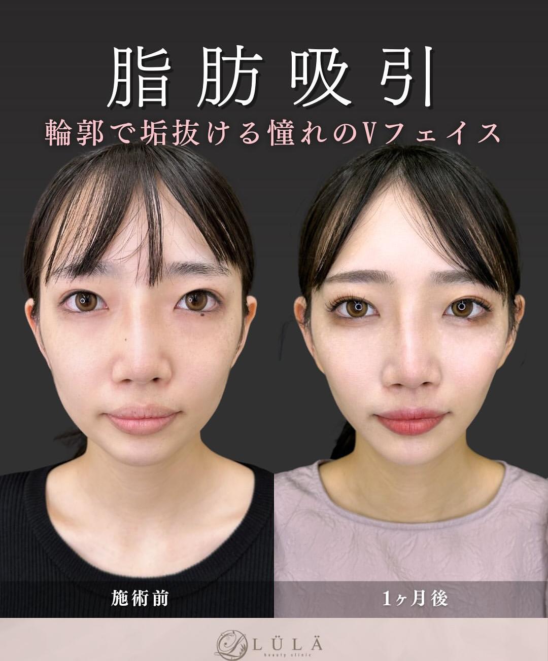 脂肪吸引の症例写真