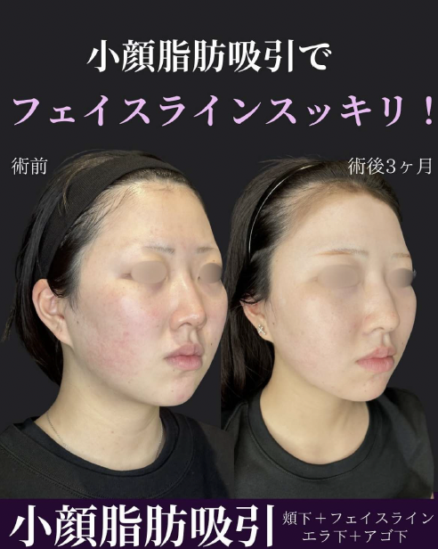 脂肪吸引の症例写真