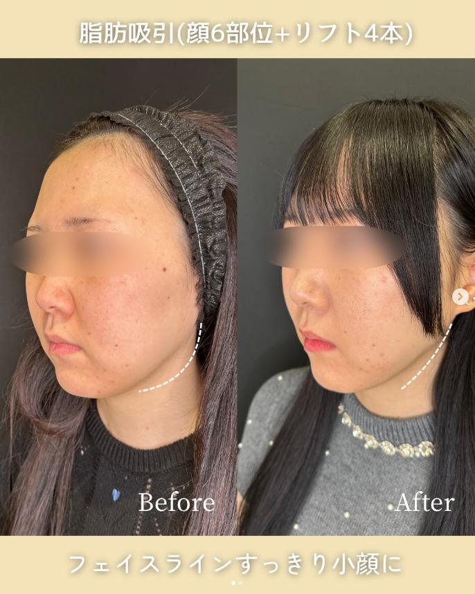 脂肪吸引の症例写真
