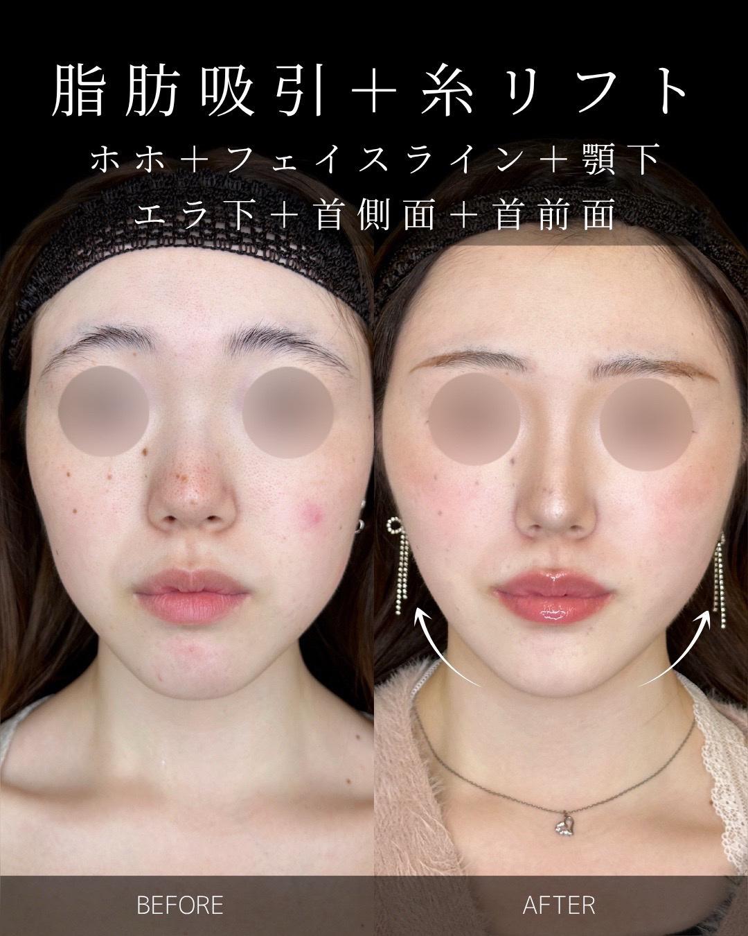 脂肪吸引の症例写真