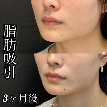 脂肪吸引の症例写真