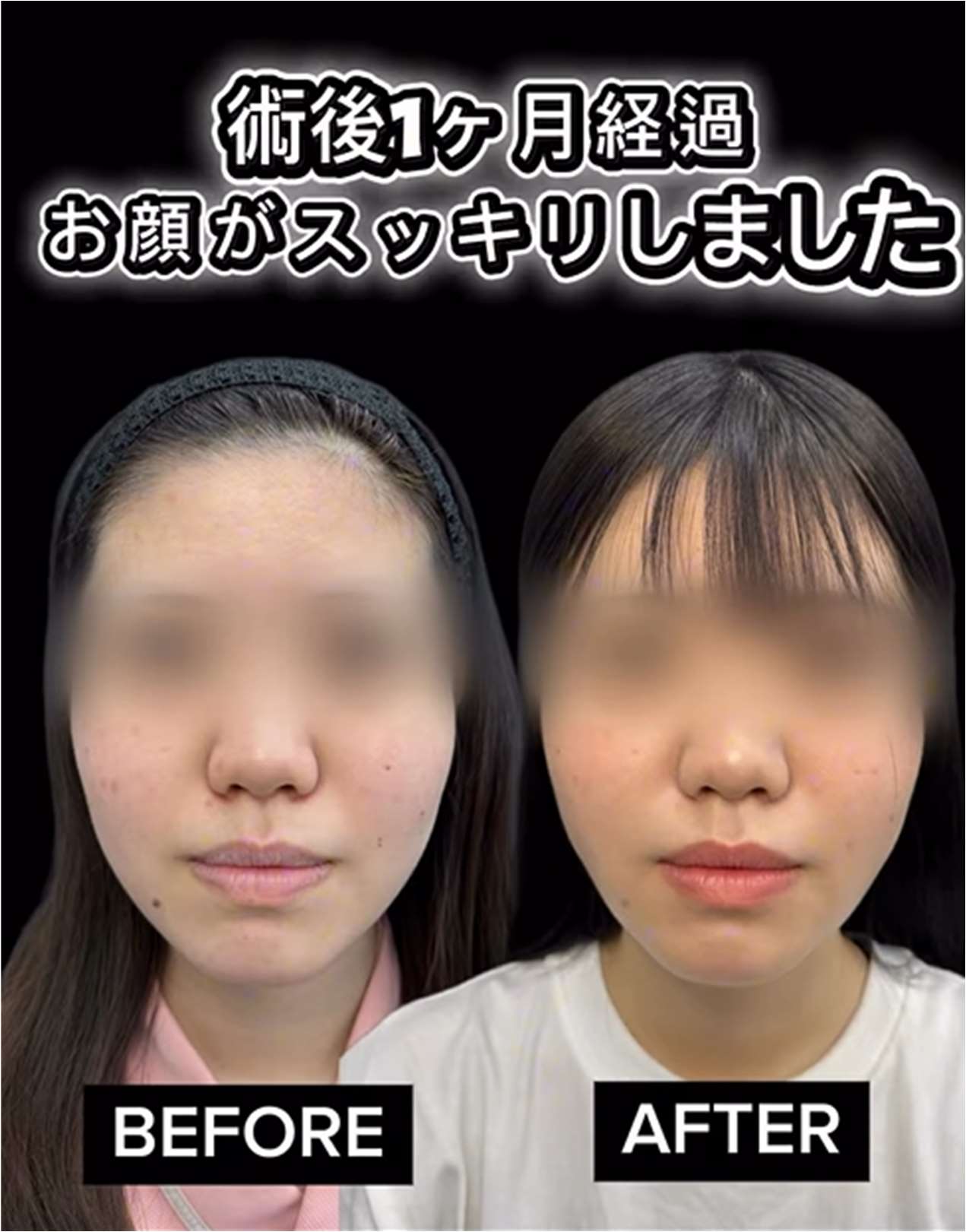脂肪吸引の症例写真