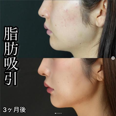 脂肪吸引の症例写真