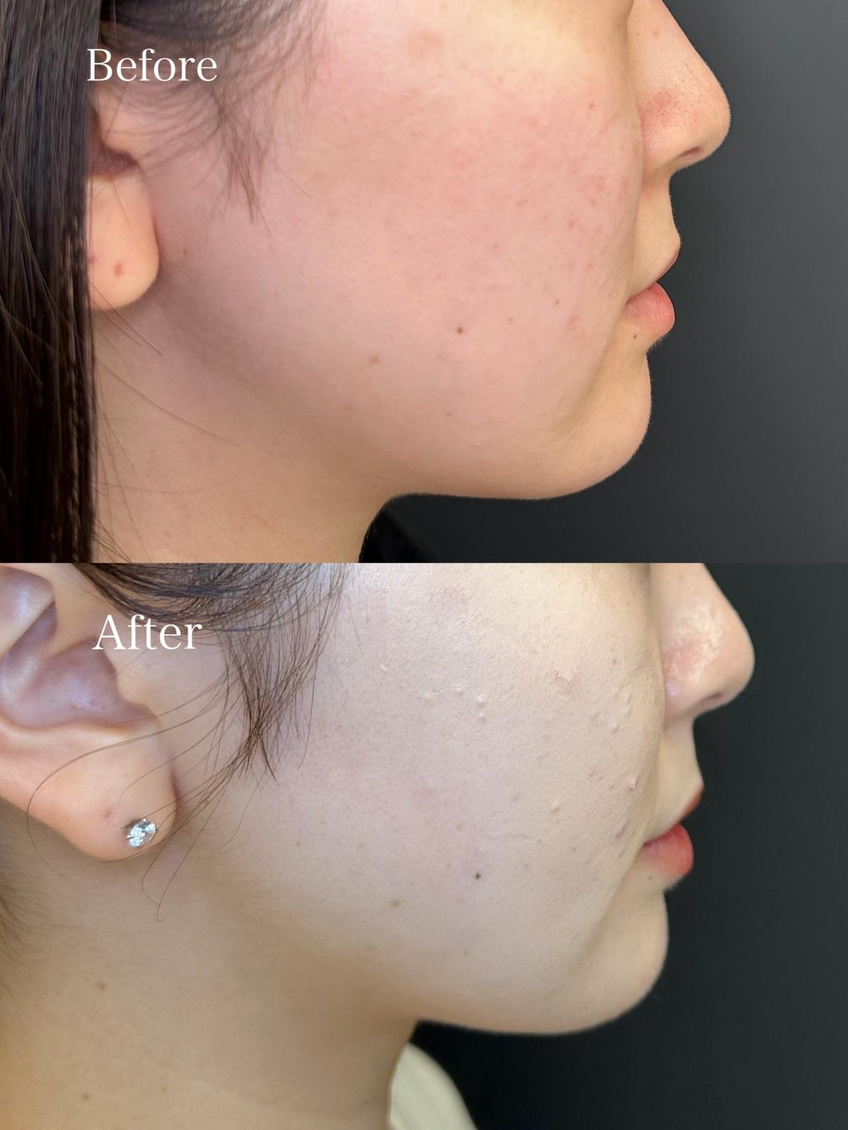 脂肪吸引の症例写真