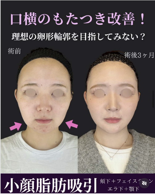 脂肪吸引の症例写真