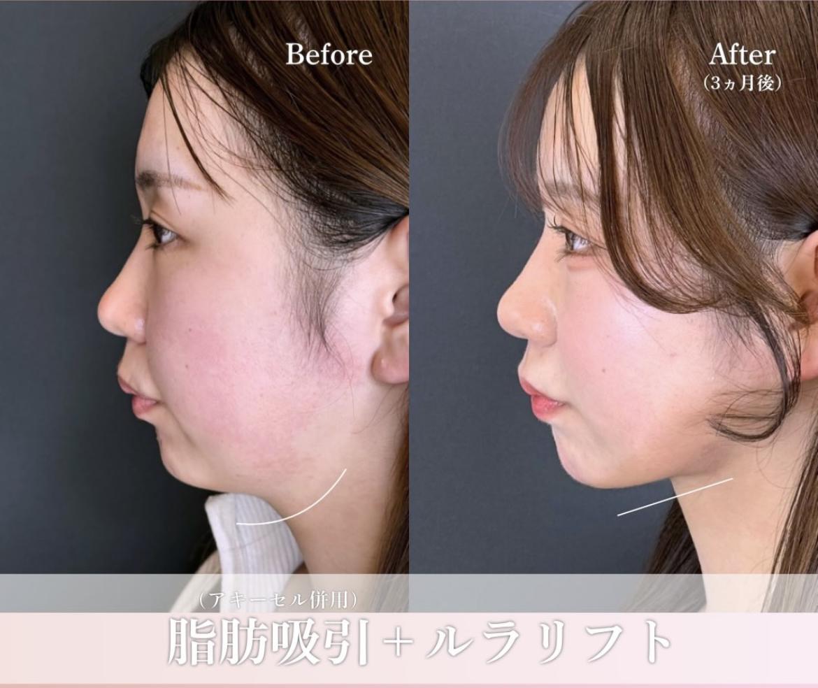 脂肪吸引の症例写真