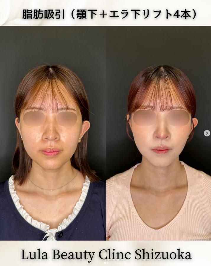 脂肪吸引の症例写真