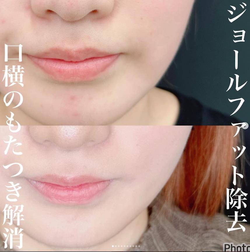バッカルファット除去の症例写真
