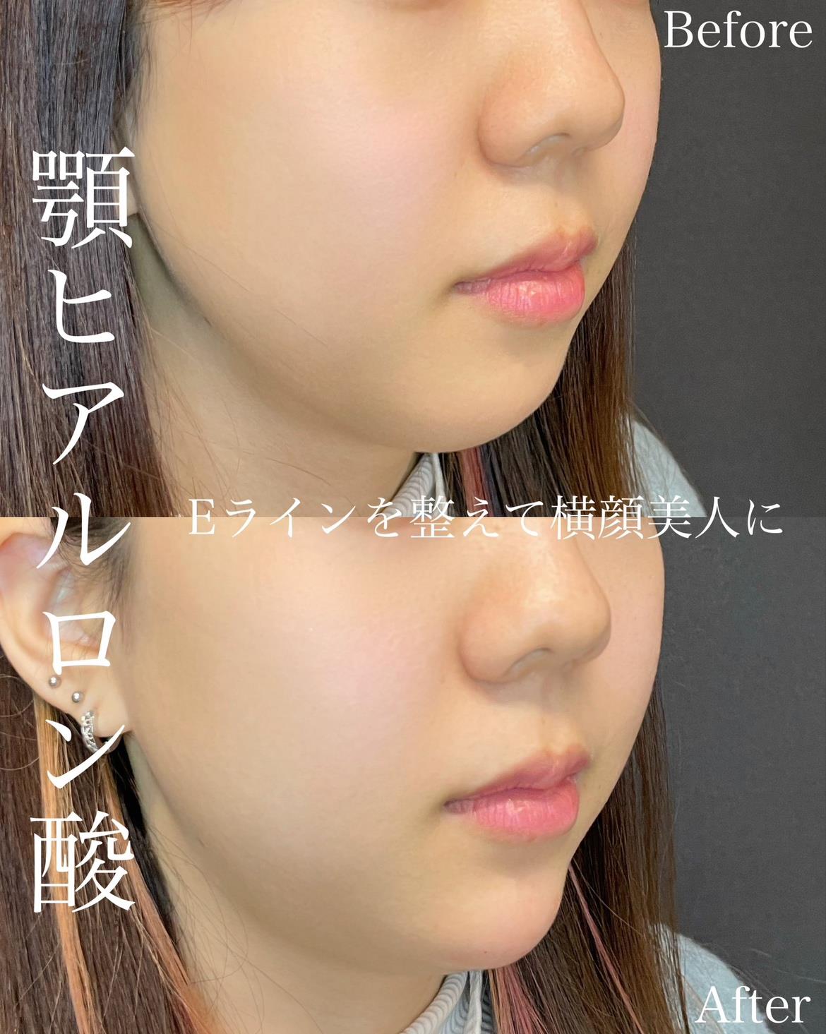 アゴクレヴィエルの症例写真