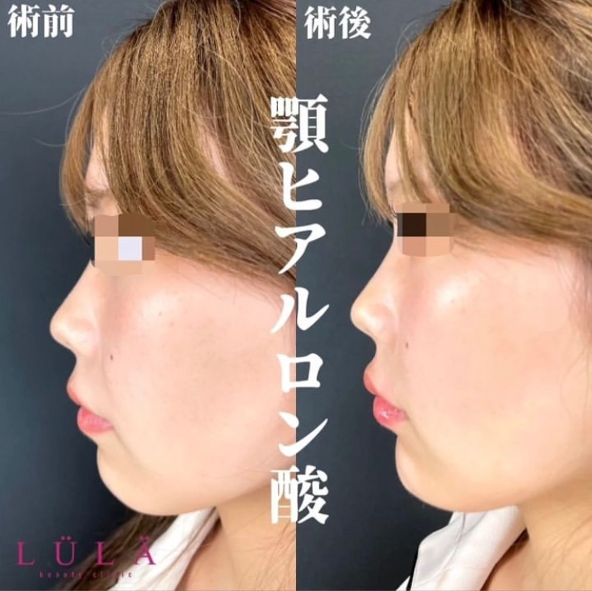 アゴクレヴィエルの症例写真