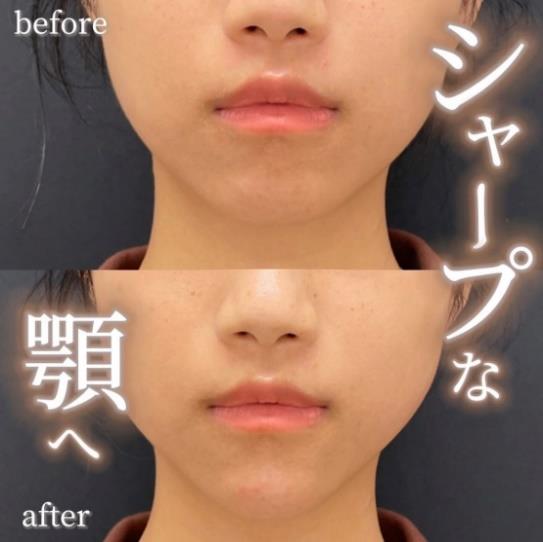 アゴクレヴィエルの症例写真