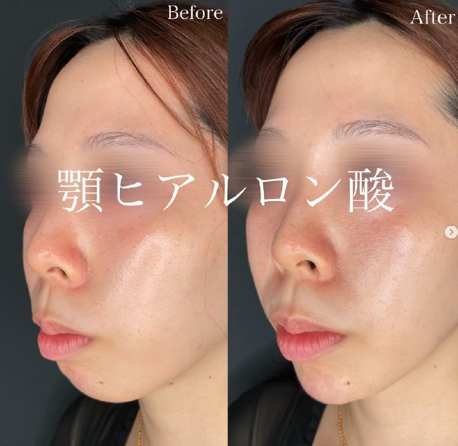 アゴボラックスの症例写真