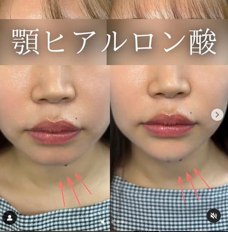 アゴクレヴィエルの症例写真