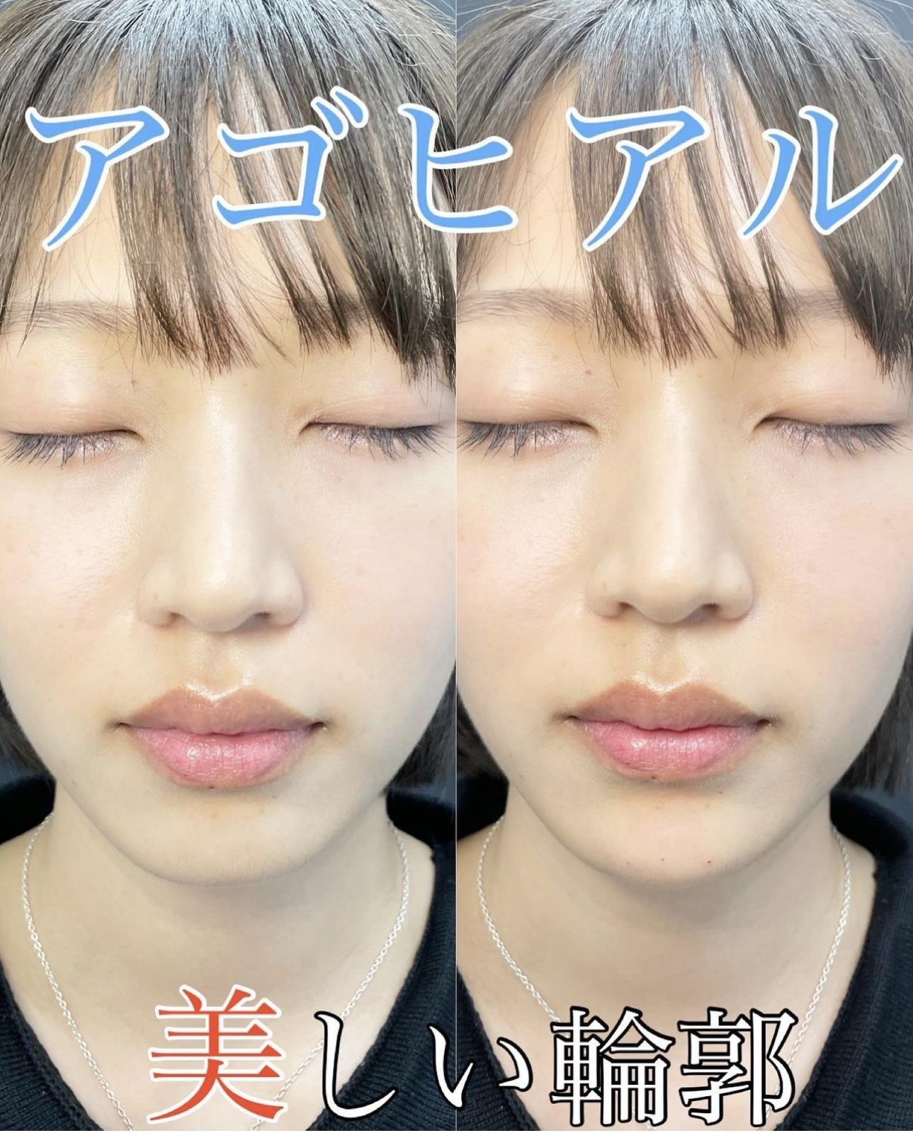 アゴクレヴィエルの症例写真