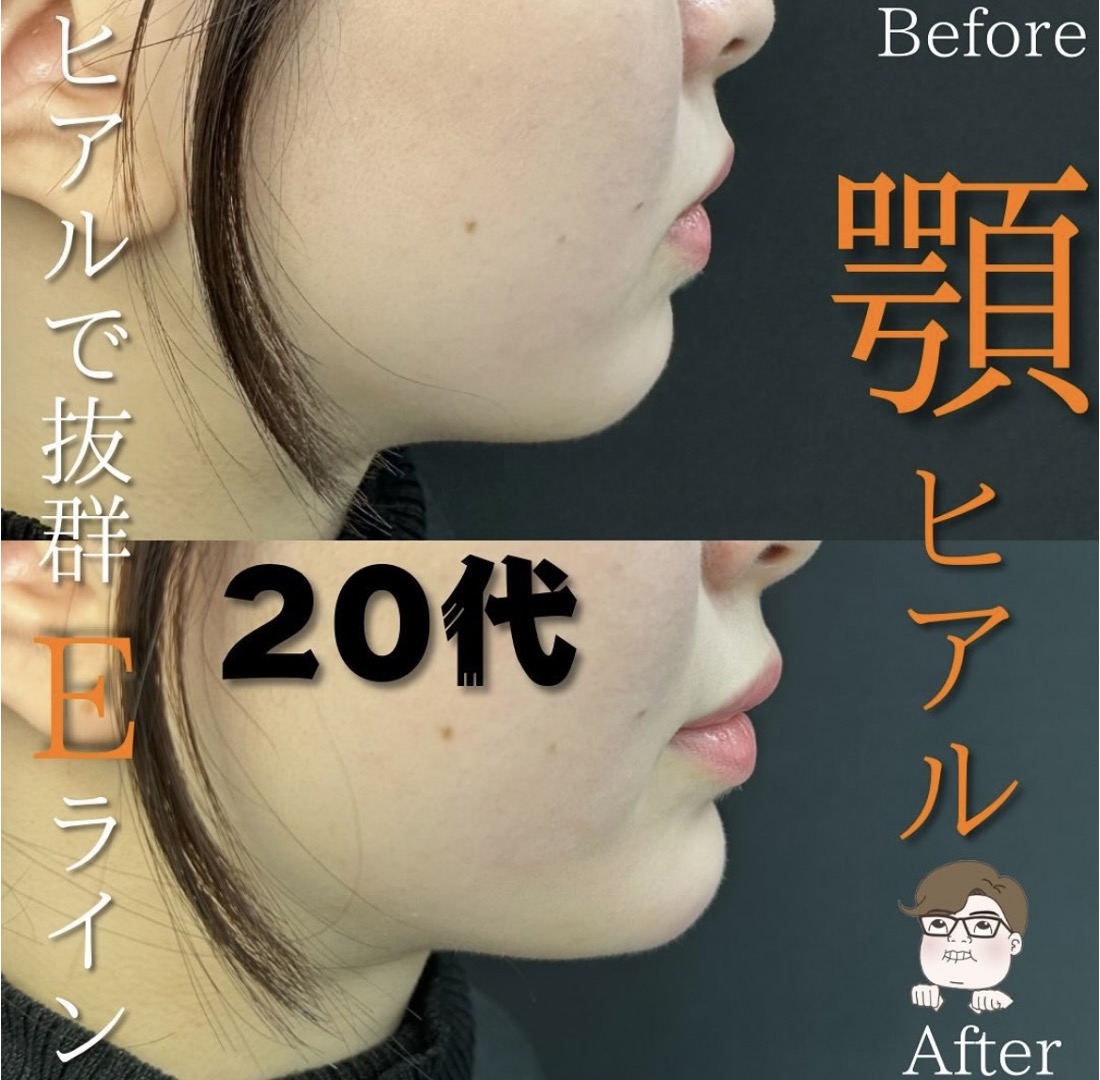 アゴヒアルロン酸(ボラックス)