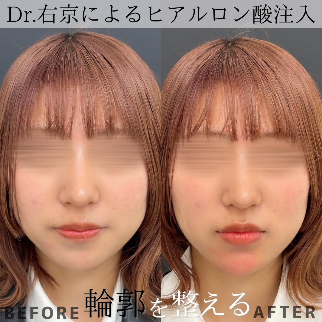 アゴヒアルロン酸(ボラックス)