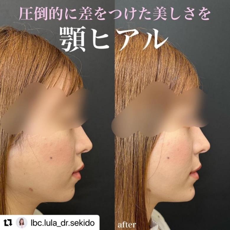 アゴヒアルロン酸(ボラックス)