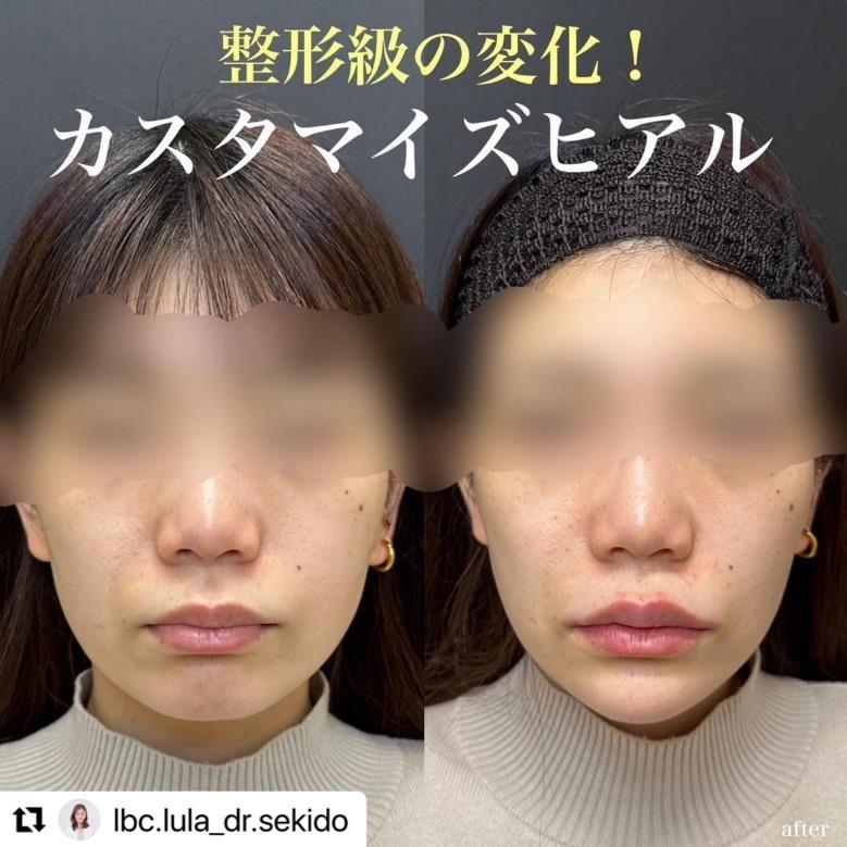 アゴヒアルロン酸(ボラックス)