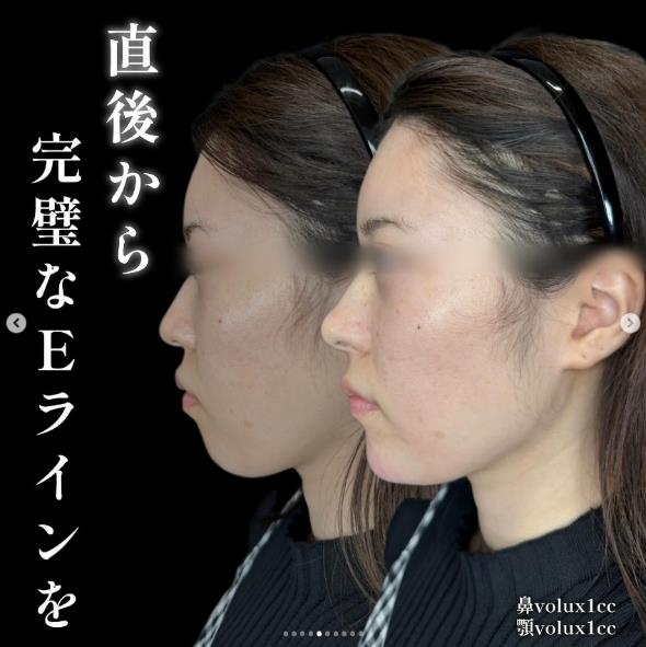 アゴクレヴィエルの症例写真