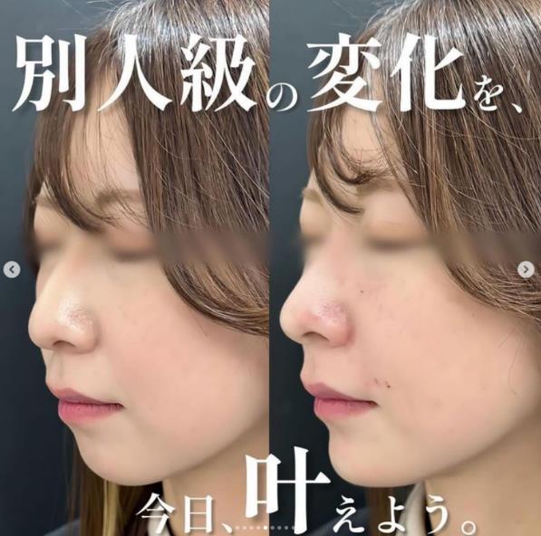 アゴクレヴィエルの症例写真