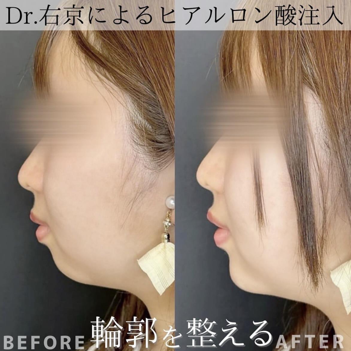 アゴクレヴィエルの症例写真