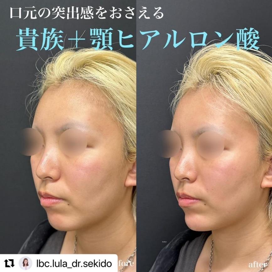 アゴクレヴィエルの症例写真