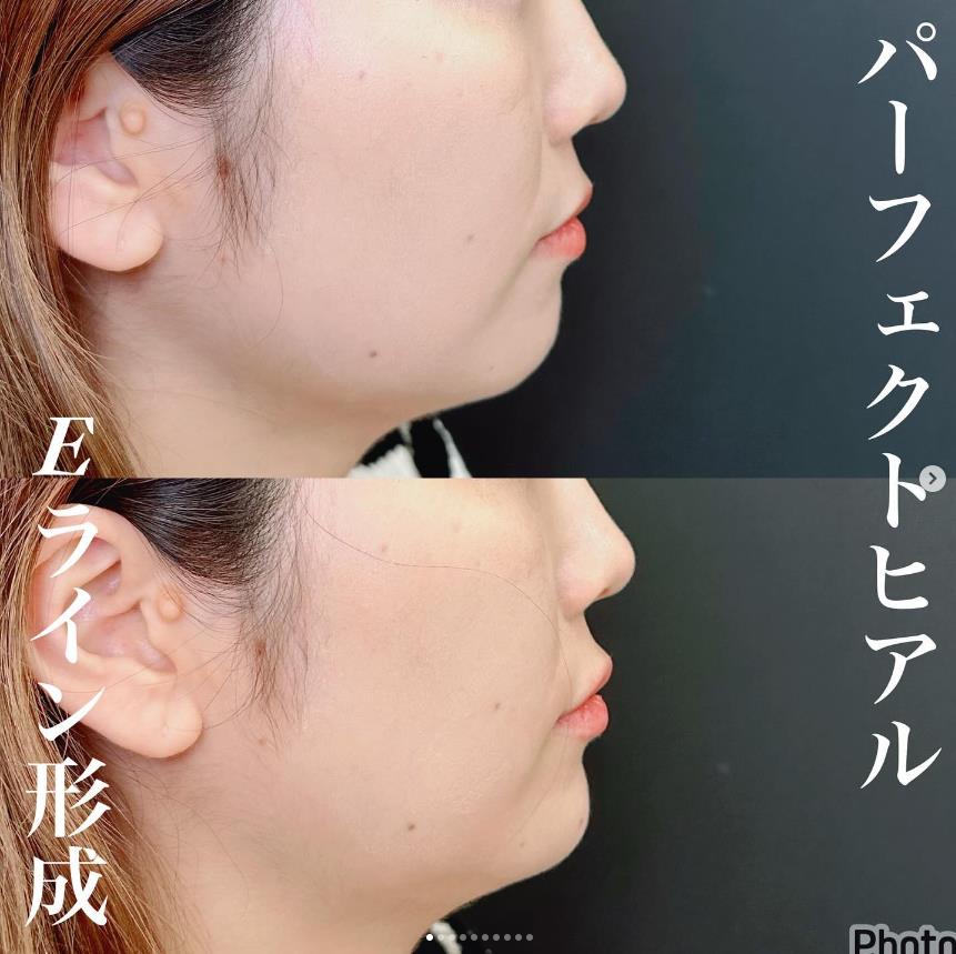 アゴクレヴィエルの症例写真