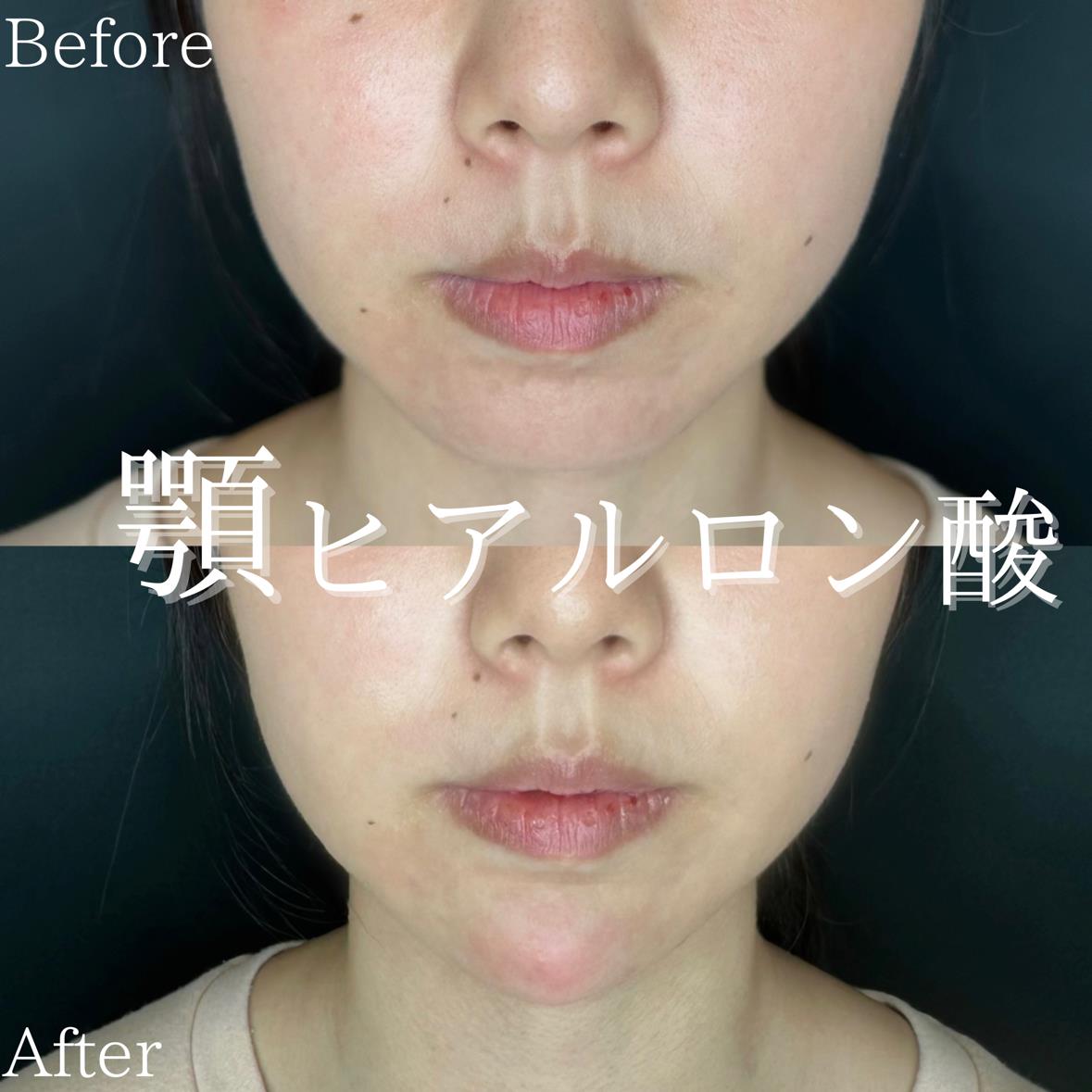 アゴクレヴィエルの症例写真