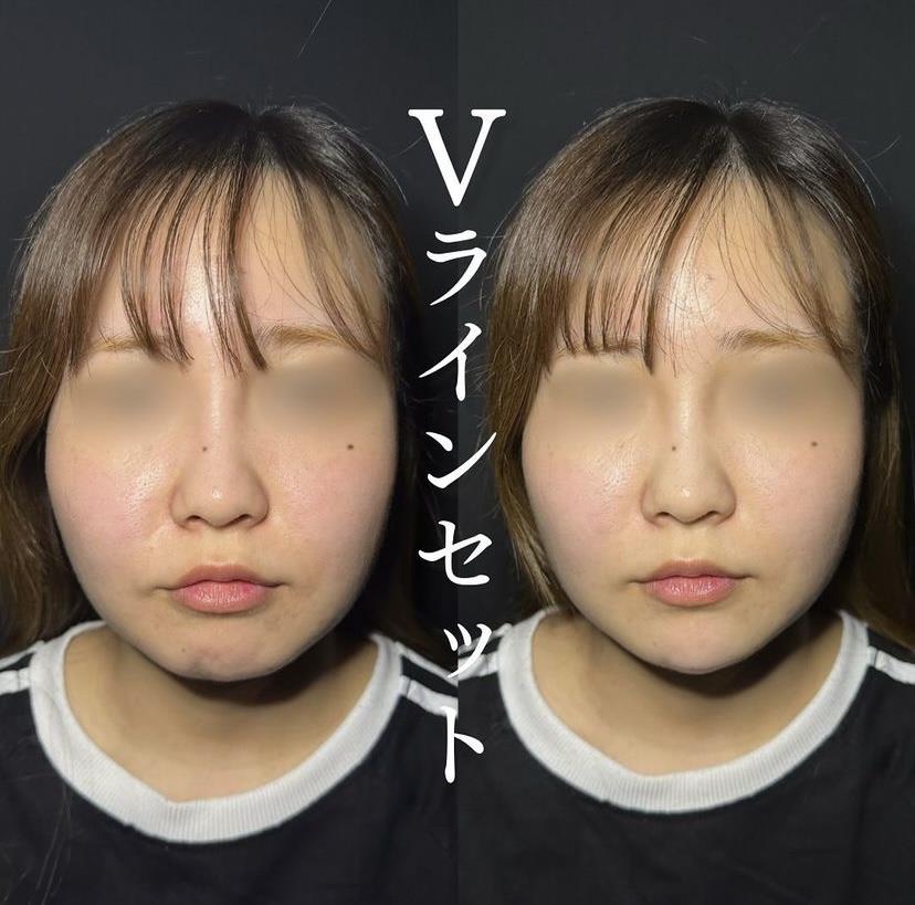 アゴクレヴィエルの症例写真