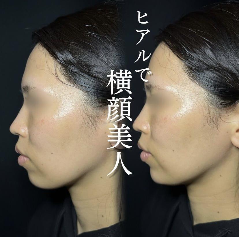 アゴクレヴィエルの症例写真