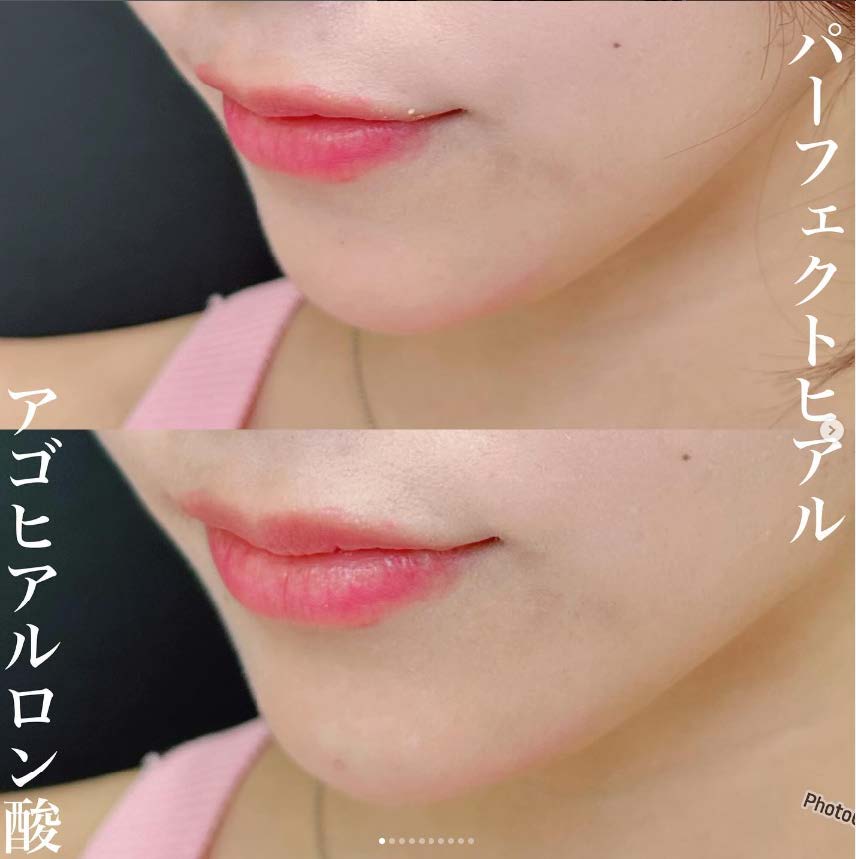 アゴクレヴィエルの症例写真