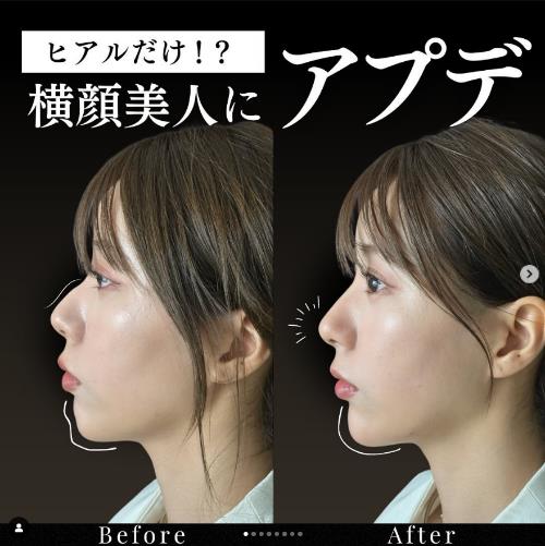 アゴクレヴィエルの症例写真