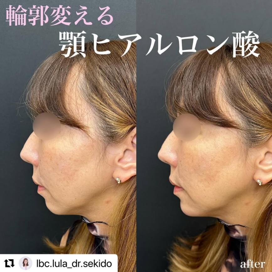 アゴクレヴィエルの症例写真