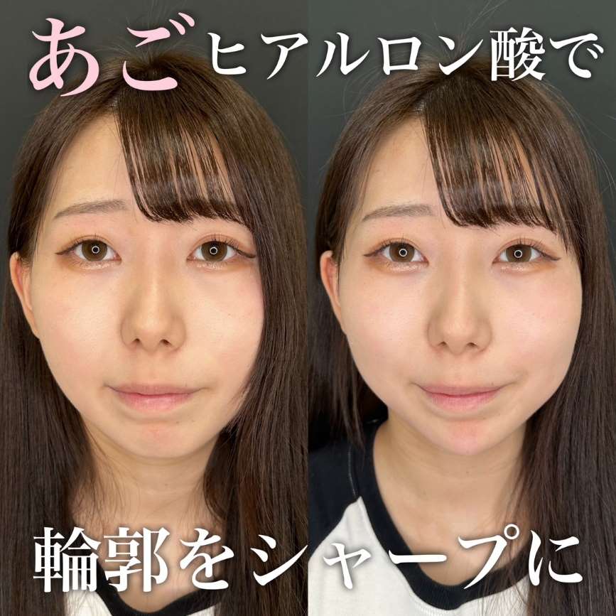 アゴクレヴィエルの症例写真