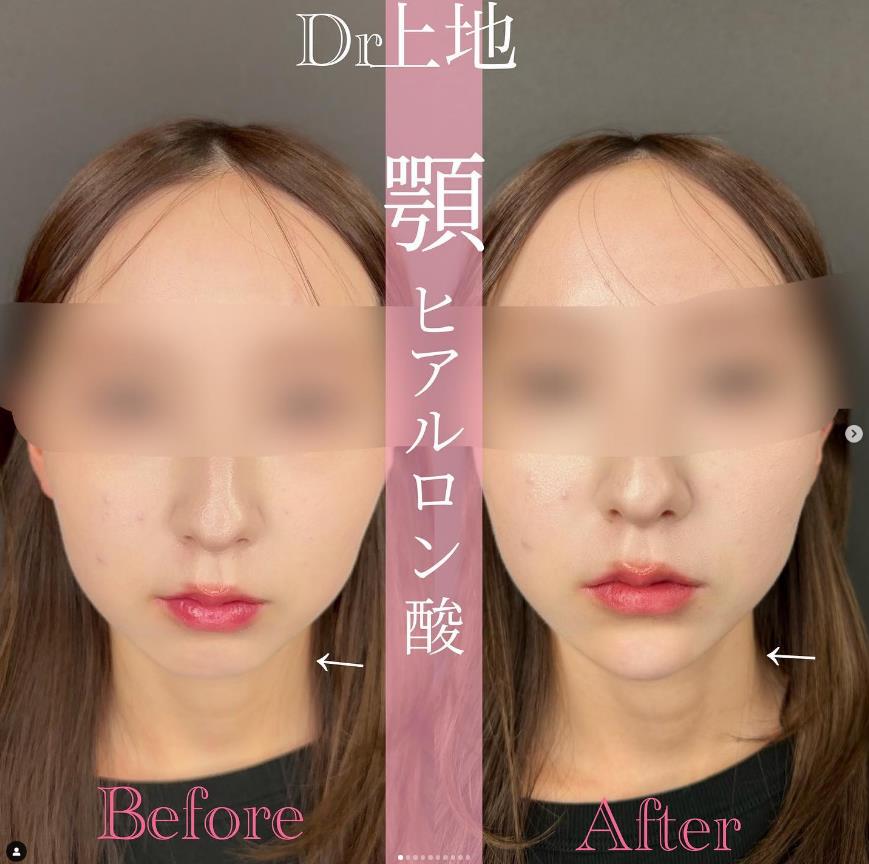 アゴクレヴィエルの症例写真