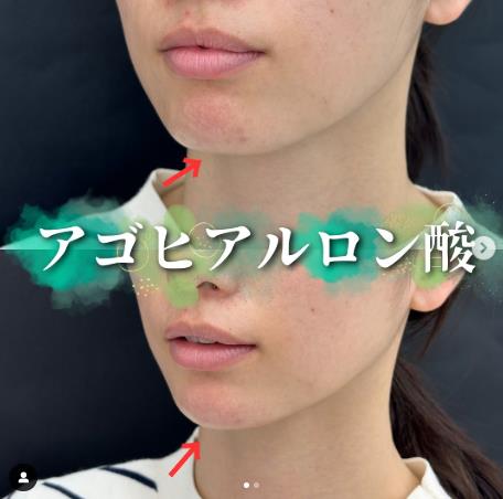 アゴクレヴィエルの症例写真