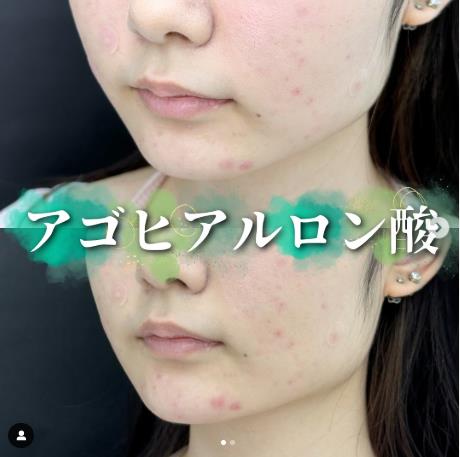 アゴクレヴィエルの症例写真