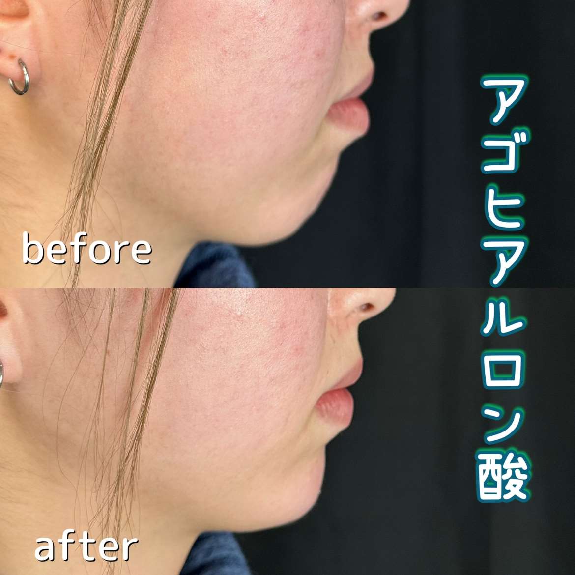 アゴクレヴィエルの症例写真