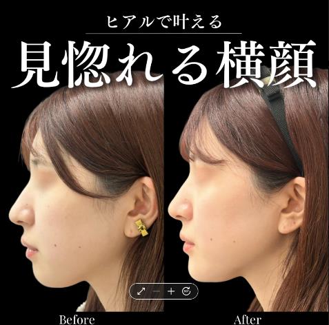 アゴボラックスの症例写真