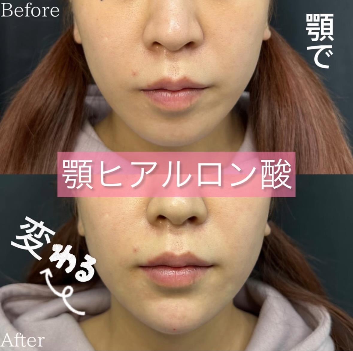 アゴボラックスの症例写真