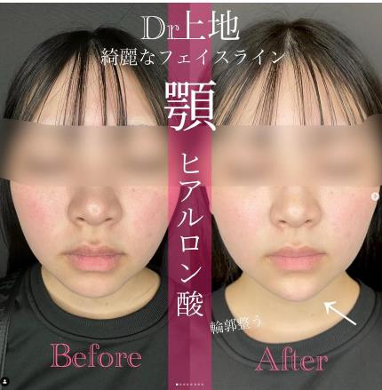 アゴクレヴィエルの症例写真