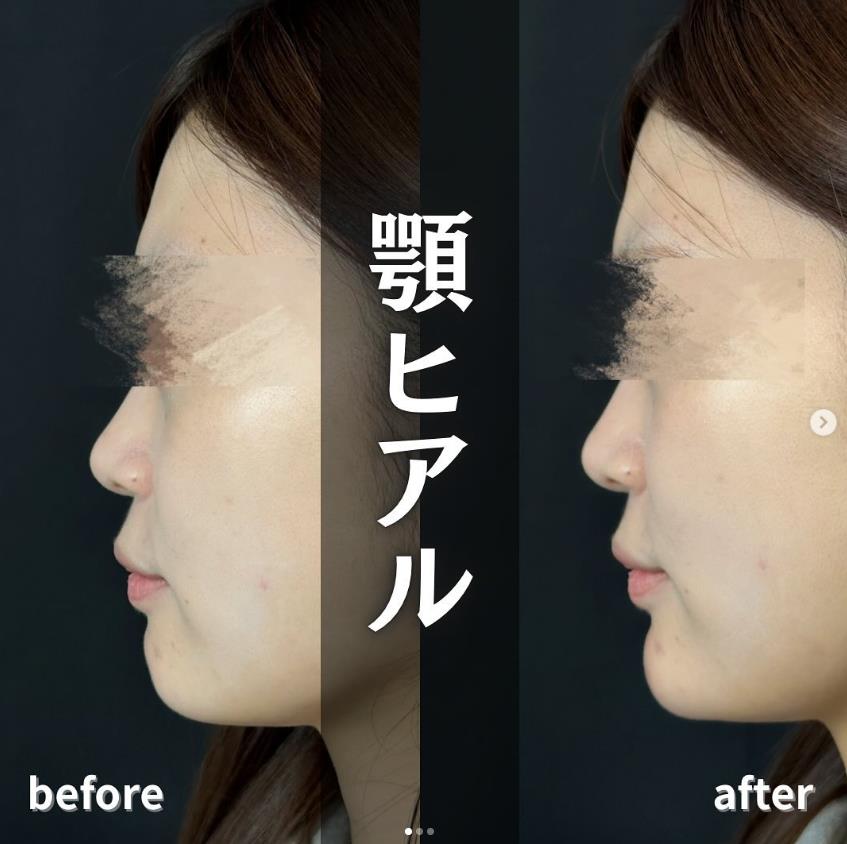 アゴクレヴィエルの症例写真