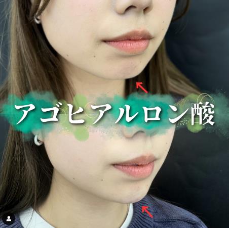アゴクレヴィエルの症例写真