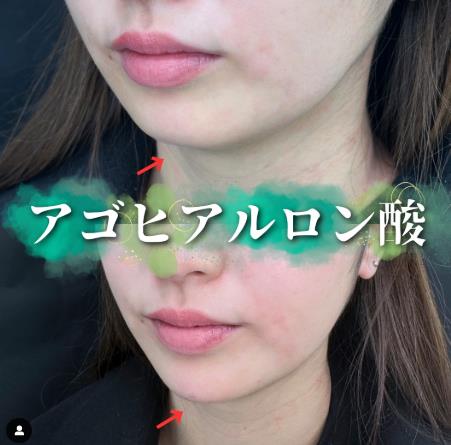 アゴクレヴィエルの症例写真